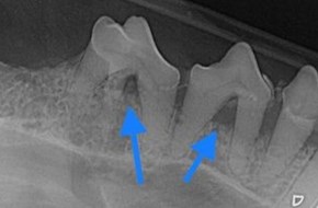 Fæstetab af knoglevæv, mellem tandens rødder